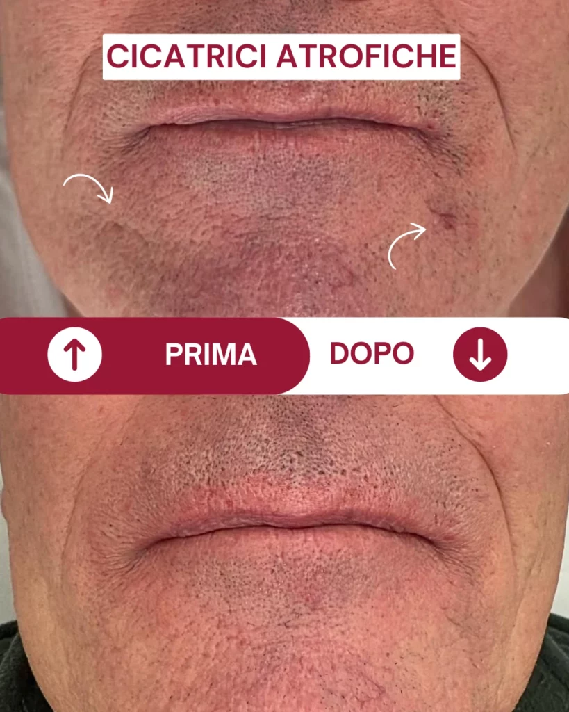 Prima e dopo di un volto che si è fatto un trattamento estetico presso Aori Medical Beauty Clinic di Varese. Sopra il prima e sotto il dopo. Sopra il volto presenta delle cicatrici atrofiche che grazie al trattamento sono riuscite ad andare via
