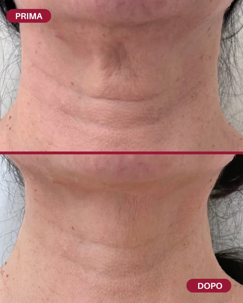 Un collo prima e dopo il filler. Nella parte superiore il prima, nella parte inferiore della foto il dopo. La pelle nella parte "dopo" è più distesa e giovane