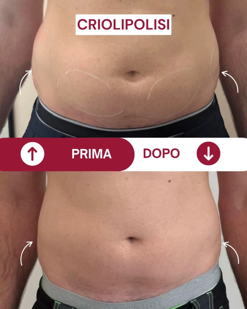 prima e dopo della criolipolisi