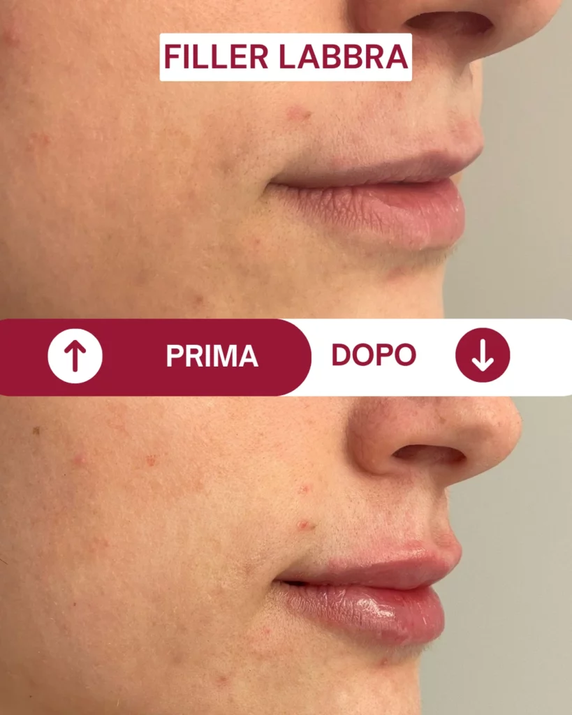 Prima e dopo di un filler labbra. Nella parte superiore dell'immagine il labbro prima del filler. Il labbro si presenta più piatto. Nella parte inferiore il labbro si presenta più voluminoso