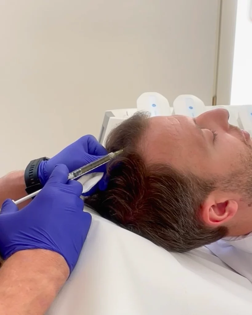 trattamento PRP presso Aori Medical Beauty Clinic