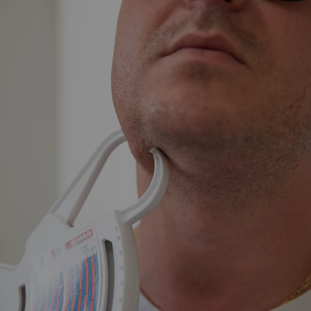 Foto di un paziente al quale viene misurato la massa di pelle sotto il mento previo trattamento presso il centro estetico Aori Medical Beauty Clinic di Varese