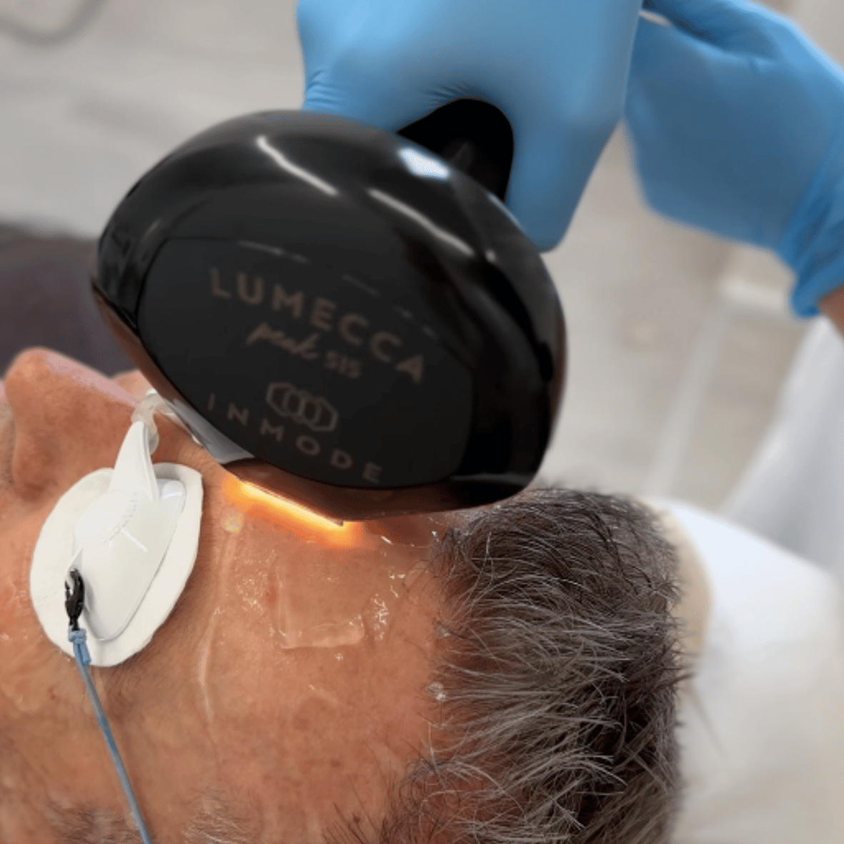Foto di un trattamento Lumecca presso Aori Medical Beauty Clinic di Varese